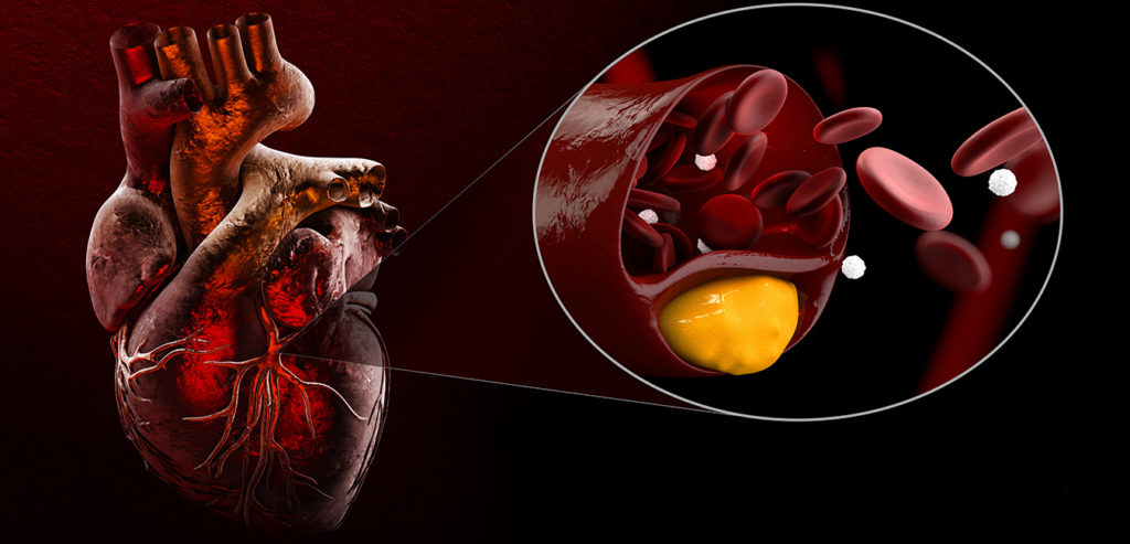 familial-hypercholesterolemia-the-hidden-cholesterol-condition